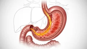Medical illustration showing stomach acid refluxing into the esophagus